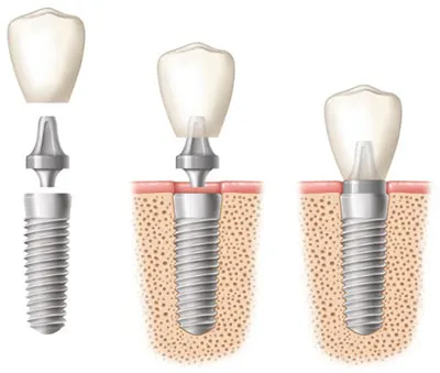 porcelain veneers