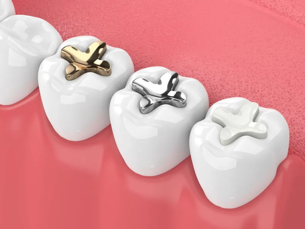 4 types of dental fillings: How to know which one you should choose?