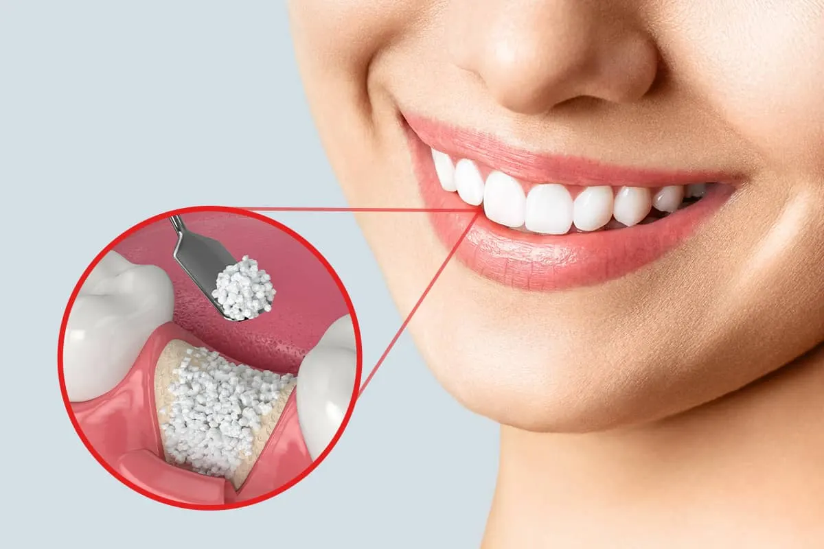 Dental Bone Graft: What It Is, How it works, Healing and Recovery