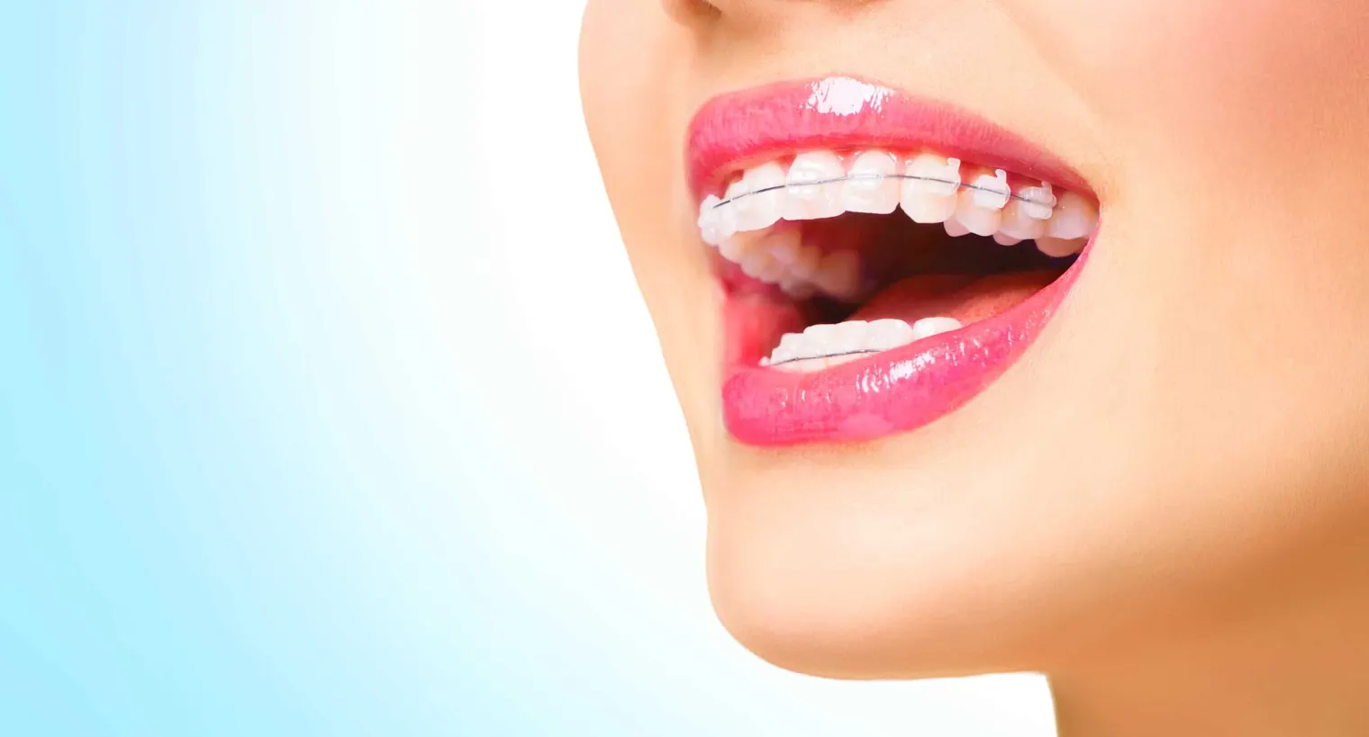 Metal Braces