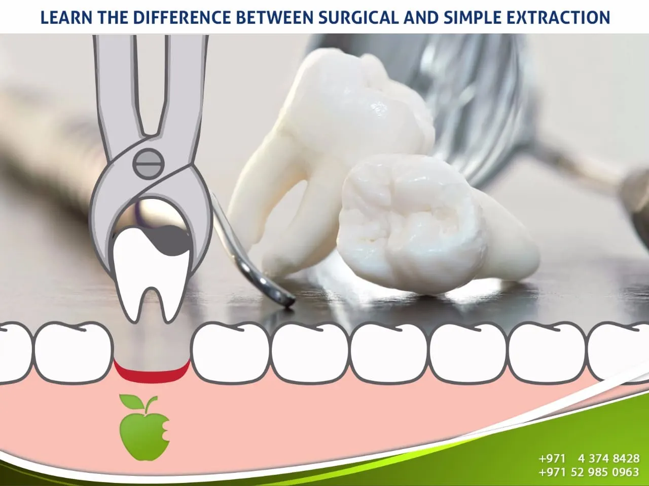 Best Dental Crowns in Dubai
