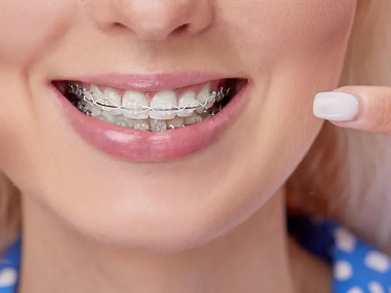 Orthodontists in Dubai: Leading the Way to Straighter, Healthier Teeth