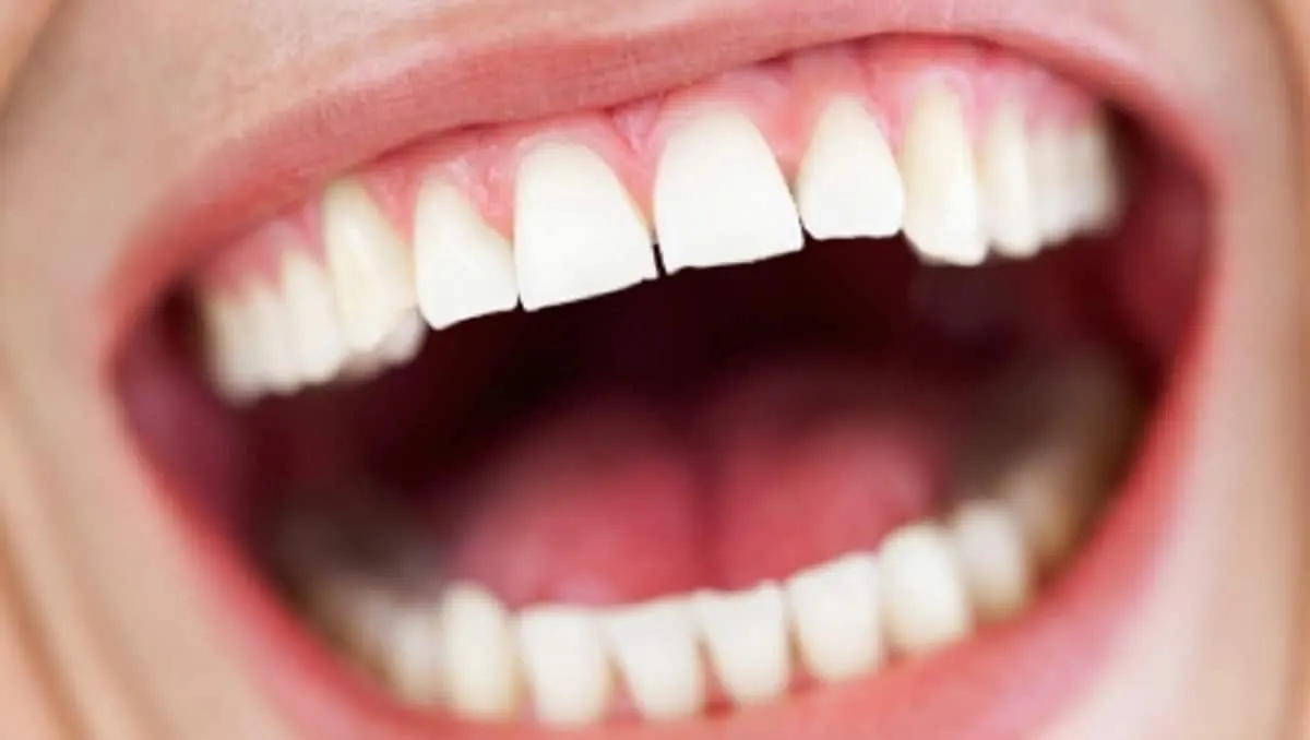 laser teeth whitening