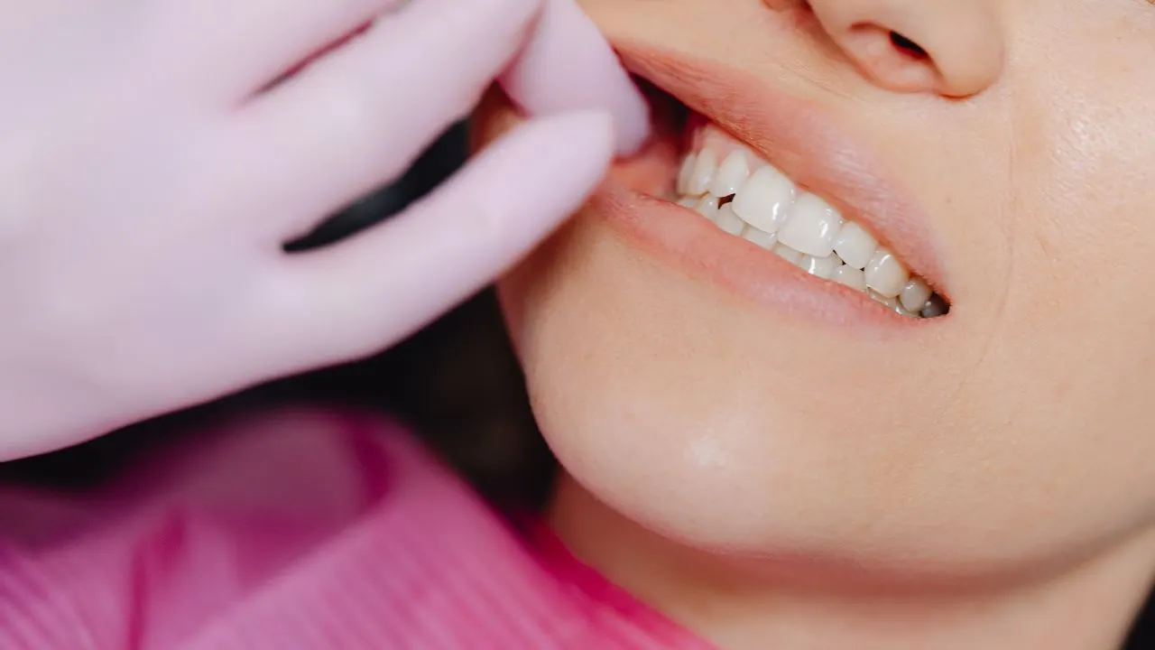 Partially impacted wisdom tooth