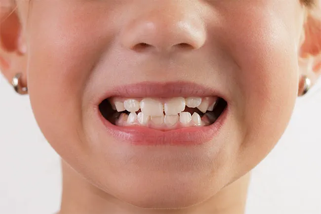 teeth braces dubai