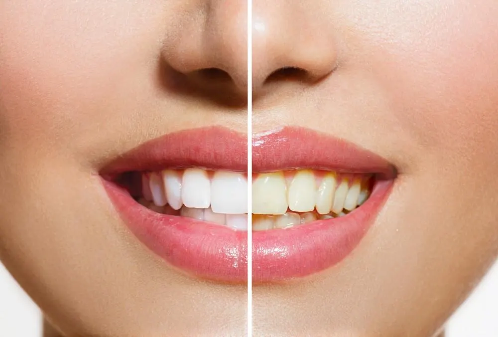 Teeth Whitening Options: Comparing Home Teeth Whitening, Laser Teeth Whitening, and Zoom Teeth Whitening