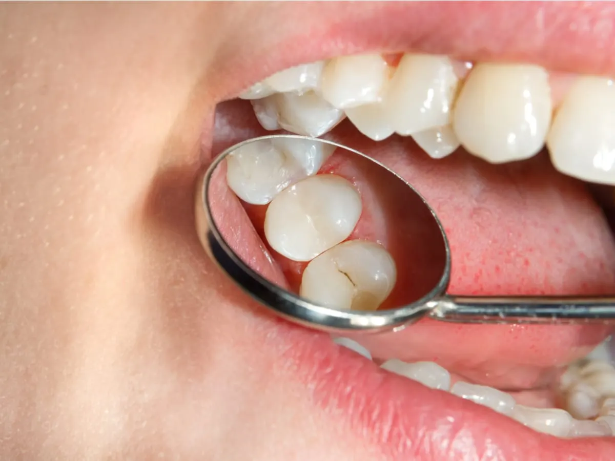 The Importance of Dental Sealants for Preventing Tooth Decay