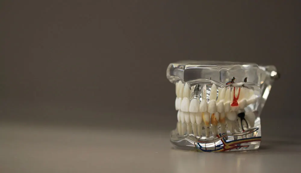 laser teeth whitening