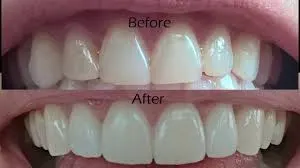 veneers in dubai
