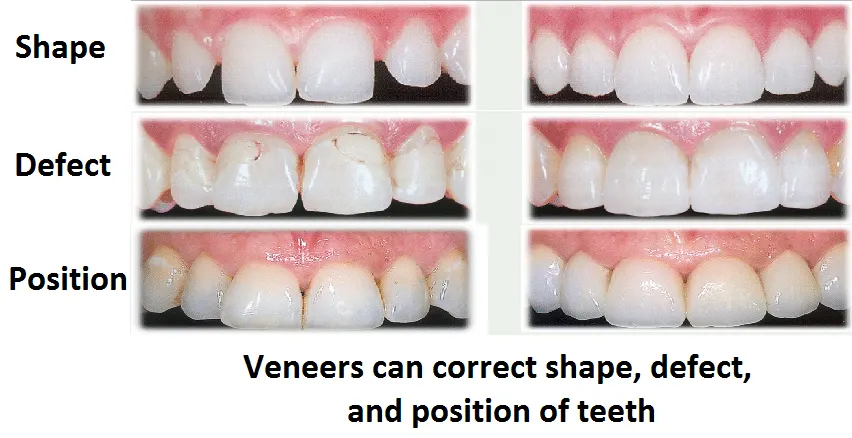 Veneers Dentist