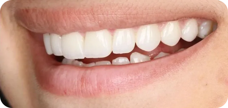 After: Minimal gum contouring along with 10 veneers