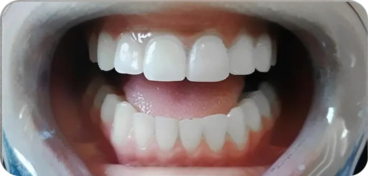 After: Composite bonding