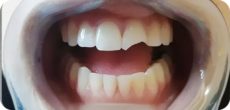 Before: Composite bonding