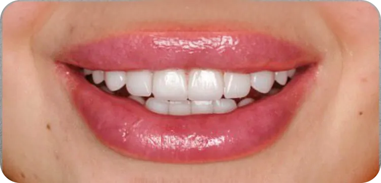 After: Veneers treatment