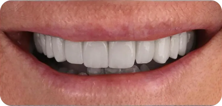 After: Veneers treatment
