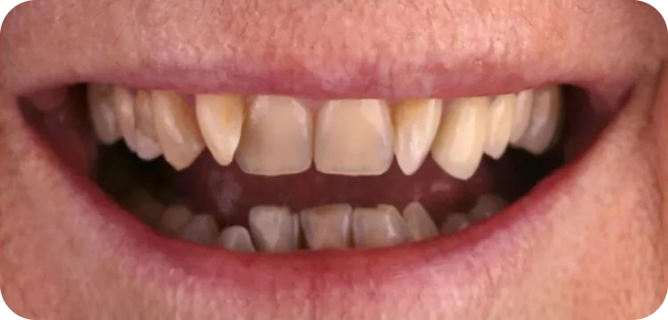 Before: Veneers treatment