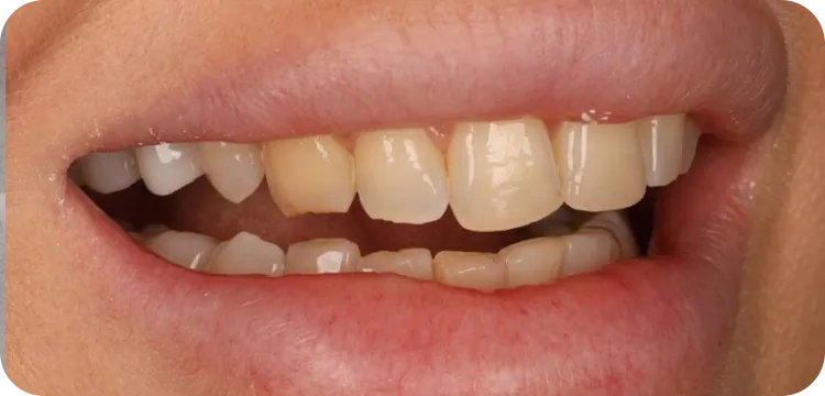 Before: Veneers treatment