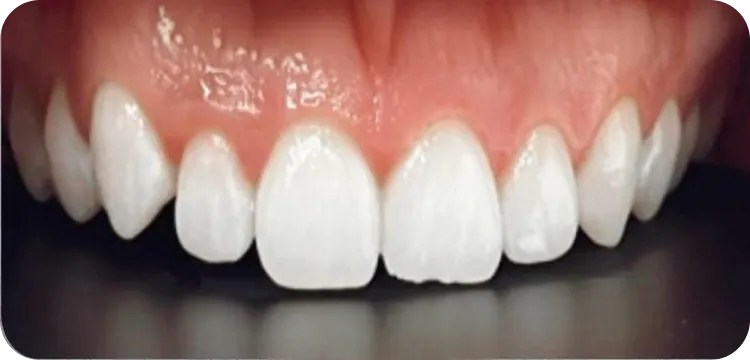 After: Teeth whitening