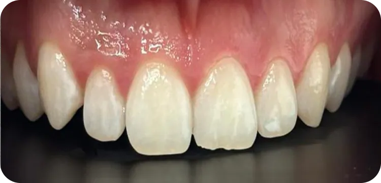 Before: Teeth whitening
