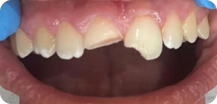 Before: Composite restoration