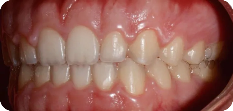 After: Edge to edge anterior bite