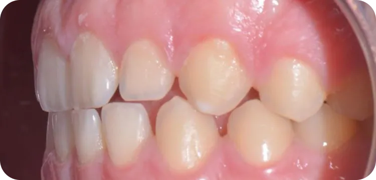 Before: Edge to edge anterior bite