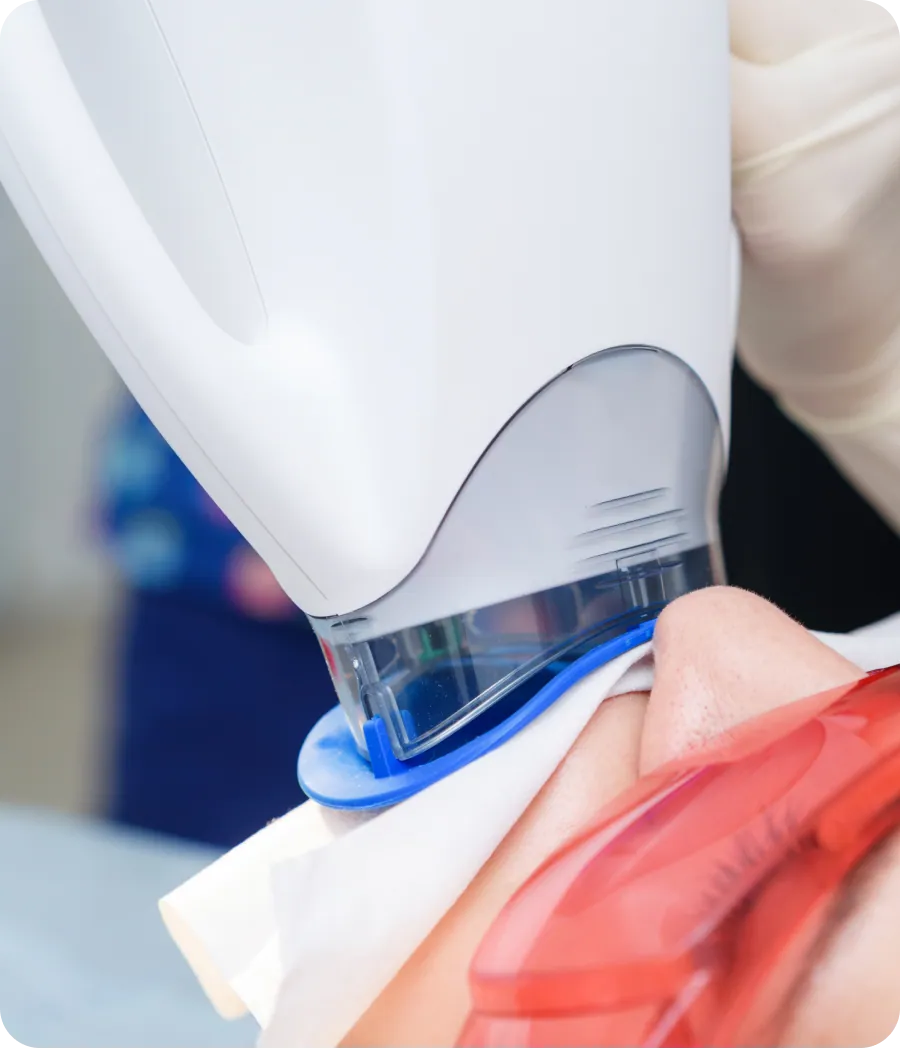 Smile after laser teeth whitening