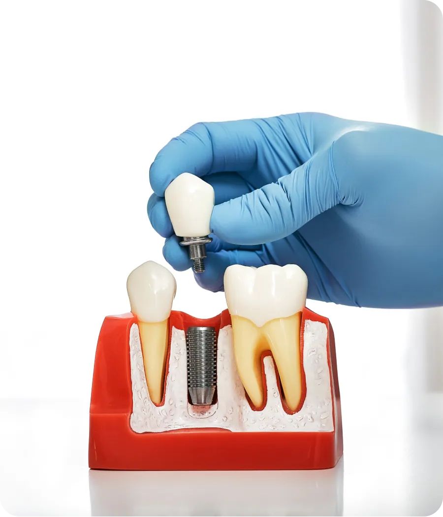 Porcelain crowns on a dental model
