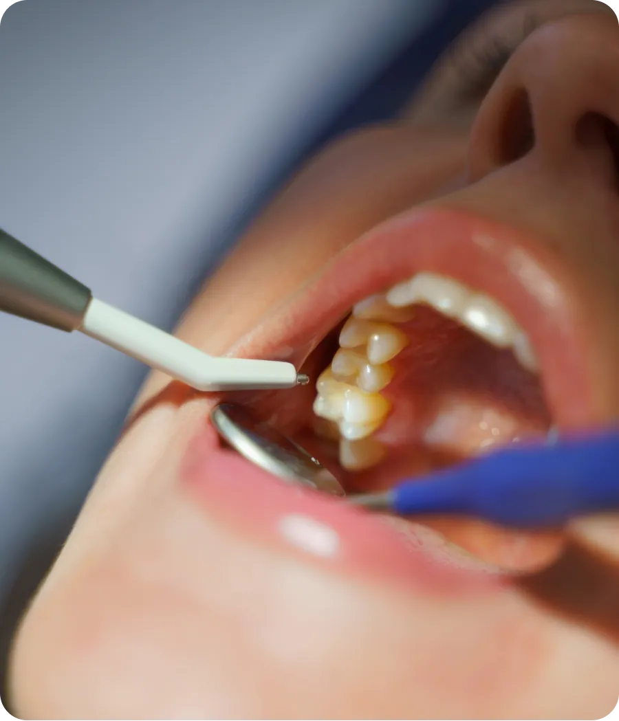 Dentist placing a tooth-colored filling