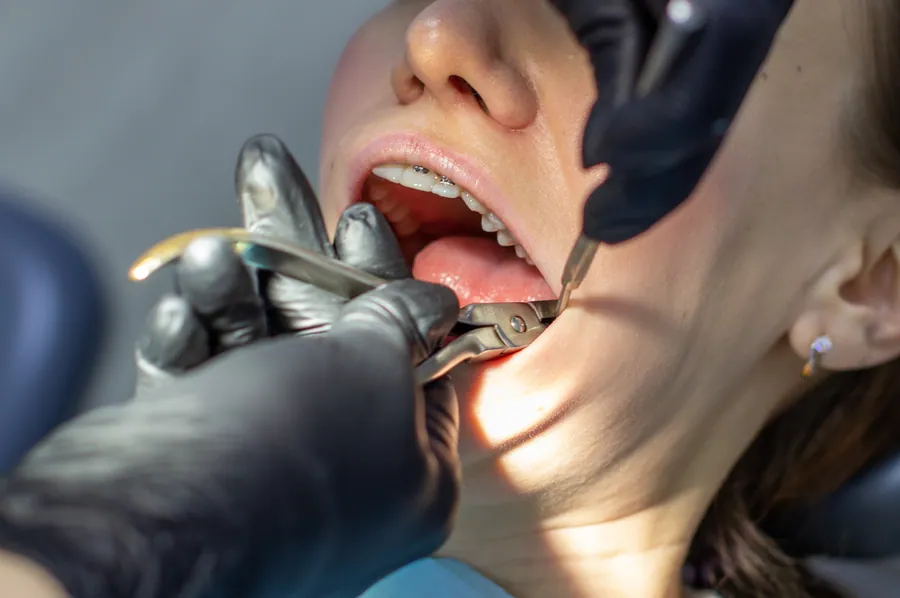 Dental X-ray showing wisdom teeth