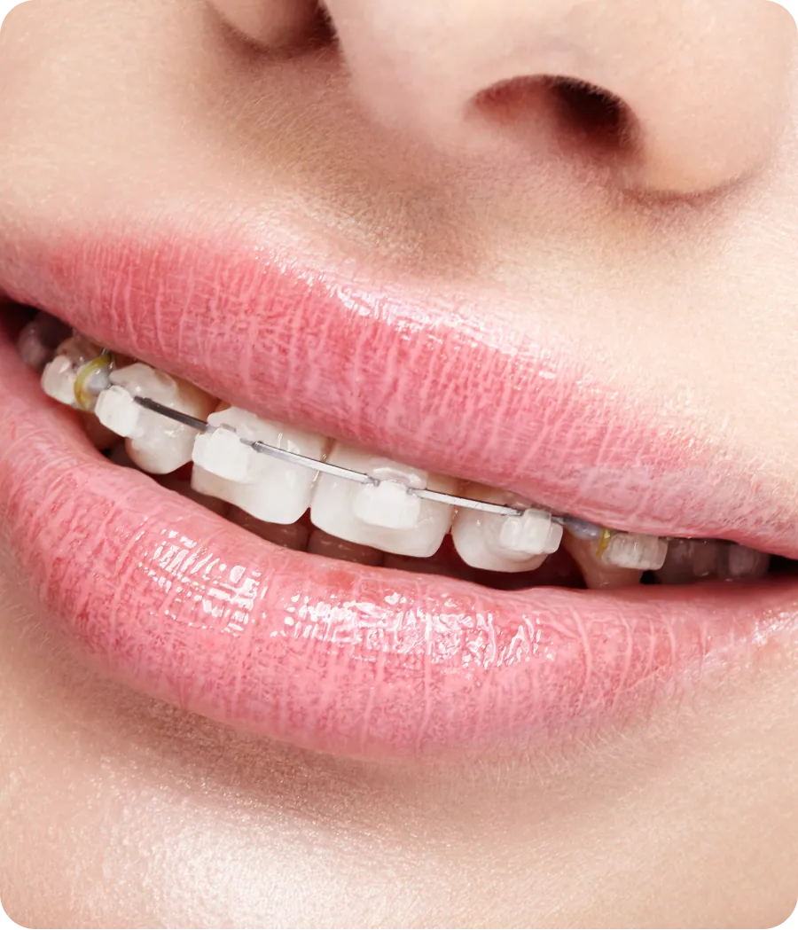 Ceramic braces on a patient's teeth