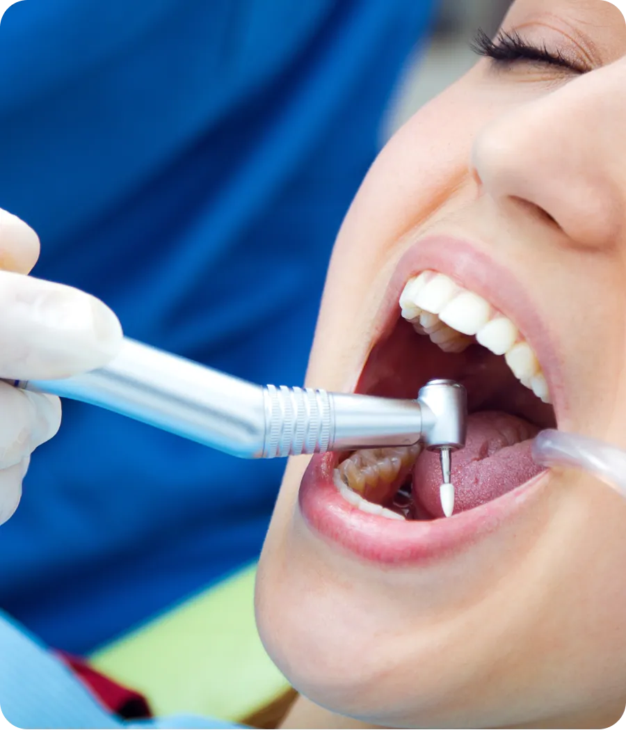 Sealant being applied to a molar