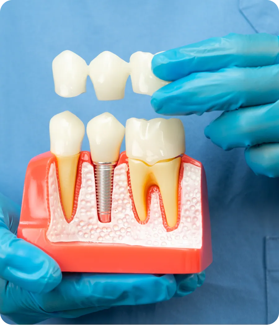 Dental bridge on a model